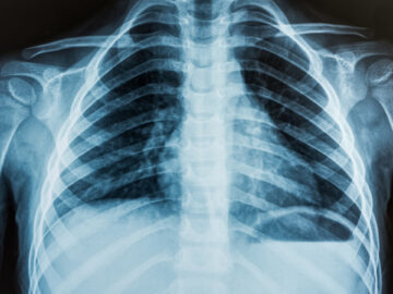 急性ケガからの回復プロセス！スピーディなリハビリテーション